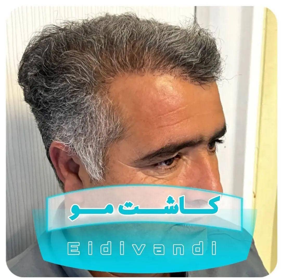 مراحل کاشت مو